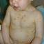 13. Baby Chicken Pox Pictures
