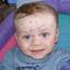 15. Baby Chicken Pox Pictures