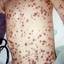 19. Baby Chicken Pox Pictures