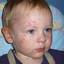 2. Baby Chicken Pox Pictures