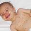 24. Baby Chicken Pox Pictures