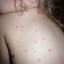 27. Baby Chicken Pox Pictures