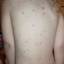 5. Baby Chicken Pox Pictures