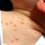 6. Baby Chicken Pox Pictures