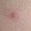 4. What are Symptoms of Chickenpox Pictures