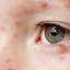 1. Chicken Pox on Eyes Pictures