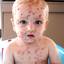 10. Chicken Pox on Head Pictures