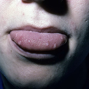 Chickenpox on Tongue