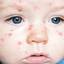 10. Chickenpox on Face Pictures