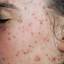 5. Chickenpox on Face Pictures