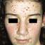 6. Chickenpox on Face Pictures
