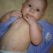 Chickenpox in Baby