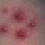 36. Chickenpox in Baby Pictures