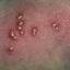 37. Chickenpox in Baby Pictures