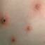 39. Chickenpox in Baby Pictures