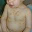 5. Chickenpox in Baby Pictures