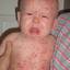 9. Chickenpox in Baby Pictures