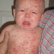 Chickenpox in Infants
