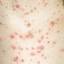 14. Adult Chickenpox Pictures