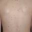 2. Adult Chickenpox Pictures