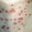 3. Adult Chickenpox Pictures