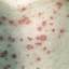 33. Adult Chickenpox Pictures