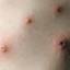 38. Adult Chickenpox Pictures