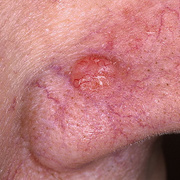 Basal Cell Carcinoma Nose