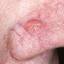 1. Basal Cell Carcinoma Nose Pictures