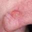 10. Basal Cell Carcinoma Nose Pictures