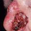 11. Basal Cell Carcinoma Nose Pictures