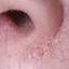 12. Basal Cell Carcinoma Nose Pictures