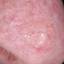13. Basal Cell Carcinoma Nose Pictures