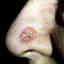 14. Basal Cell Carcinoma Nose Pictures