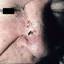15. Basal Cell Carcinoma Nose Pictures