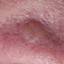 17. Basal Cell Carcinoma Nose Pictures