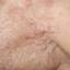 18. Basal Cell Carcinoma Nose Pictures