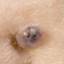 19. Basal Cell Carcinoma Nose Pictures