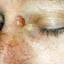 2. Basal Cell Carcinoma Nose Pictures