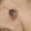 20. Basal Cell Carcinoma Nose Pictures
