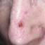 21. Basal Cell Carcinoma Nose Pictures