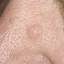 22. Basal Cell Carcinoma Nose Pictures