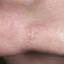 23. Basal Cell Carcinoma Nose Pictures