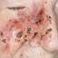 24. Basal Cell Carcinoma Nose Pictures