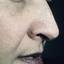 26. Basal Cell Carcinoma Nose Pictures