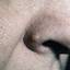 27. Basal Cell Carcinoma Nose Pictures