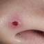 29. Basal Cell Carcinoma Nose Pictures