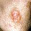 3. Basal Cell Carcinoma Nose Pictures
