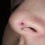 30. Basal Cell Carcinoma Nose Pictures