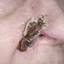 32. Basal Cell Carcinoma Nose Pictures